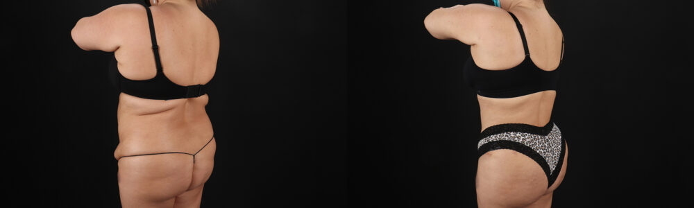 Tummy Tuck case #259095