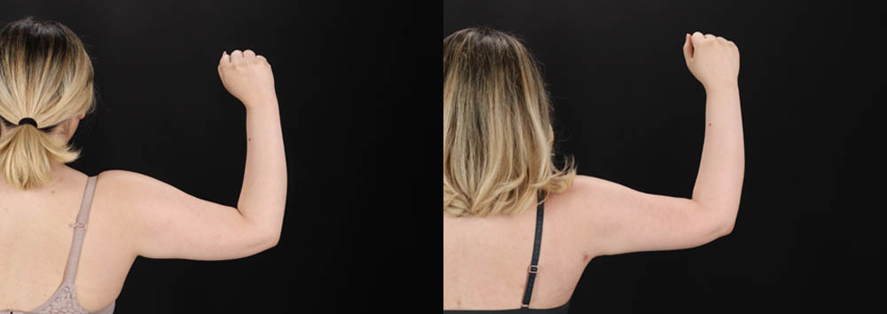 Brazilian Butt Lift case #258772