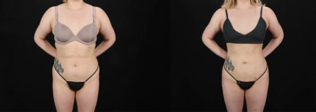 Brazilian Butt Lift case #258772
