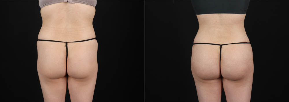 Brazilian Butt Lift case #258772