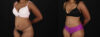Tummy Tuck case #260120 slider thumbnail