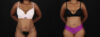 Tummy Tuck case #260120 slider thumbnail