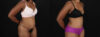 Tummy Tuck case #260120 slider thumbnail