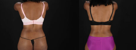 Tummy Tuck case #260120
