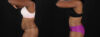 Tummy Tuck case #260120 slider thumbnail