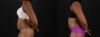 Tummy Tuck case #260120 slider thumbnail