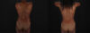 Mommy Makeover case #260092 slider thumbnail