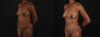 Mommy Makeover case #260092 slider thumbnail