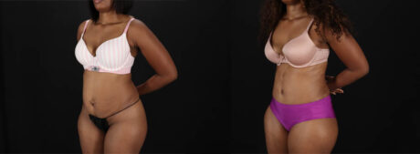 Tummy Tuck case #260120