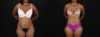 Tummy Tuck case #260120 slider thumbnail
