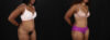 Tummy Tuck case #260120 slider thumbnail