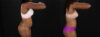 Tummy Tuck case #260120 slider thumbnail