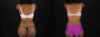 Tummy Tuck case #260120 slider thumbnail