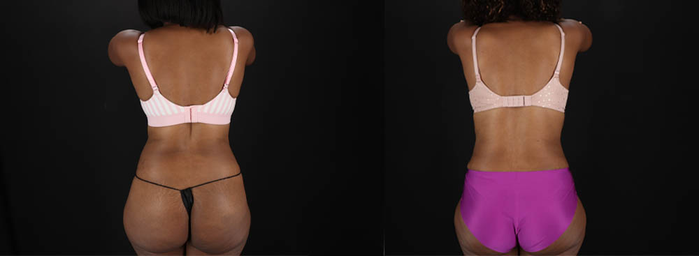 Tummy Tuck case #260120