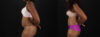 Tummy Tuck case #260120 slider thumbnail