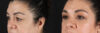 Blepharoplasty case #260106 slider thumbnail