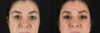 Blepharoplasty case #260106 slider thumbnail