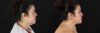 Renuvion RF Skin Tightening case #260099 slider thumbnail