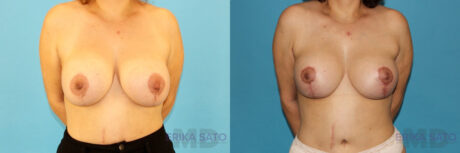 Breast Lift with Implants case #261019
