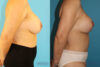 Breast Lift with Implants case #261019 slider thumbnail