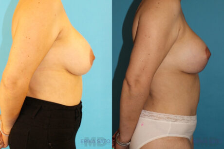 Breast Lift with Implants case #261019