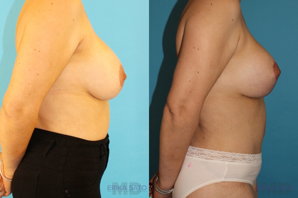 Breast Lift with Implants case #261019