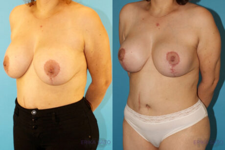 Breast Lift with Implants case #261019