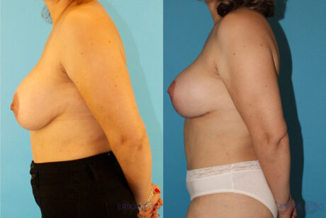 Breast Lift with Implants case #261019