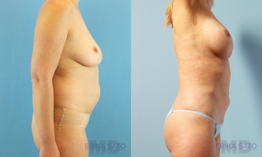 Fat Grafting to the Breast case #261036