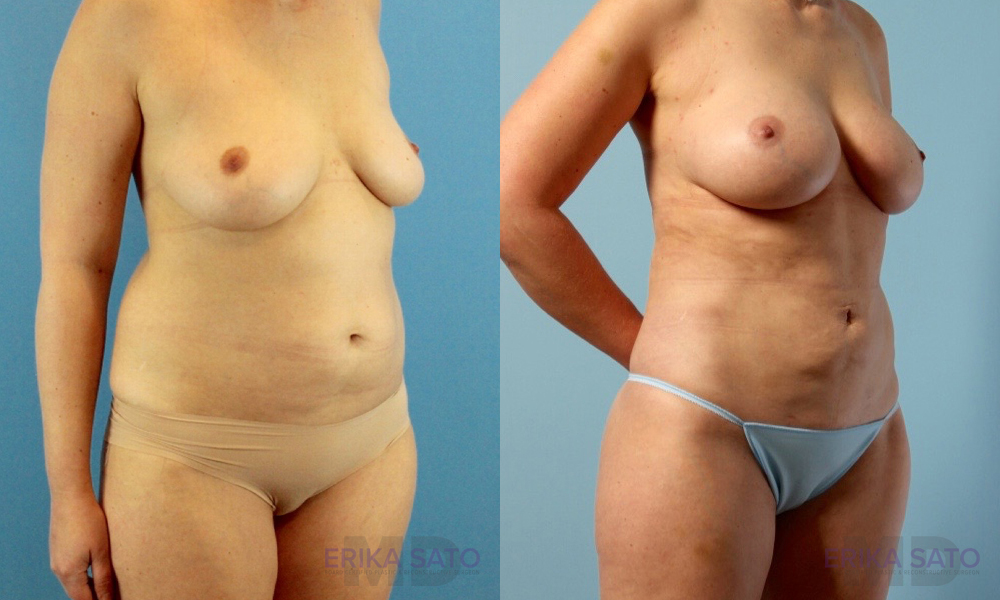 Fat Grafting to the Breast case #261036