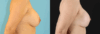 Breast Lift with Implants case #261019 slider thumbnail