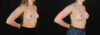 Breast Augmentation case #261355 slider thumbnail