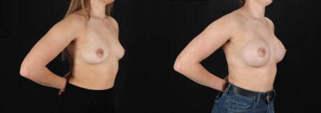 Breast Augmentation case #261355