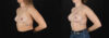 Breast Augmentation case #261355 slider thumbnail