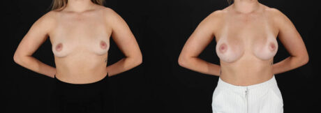Breast Augmentation case #261355