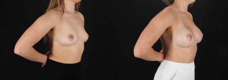 Breast Augmentation case #261355