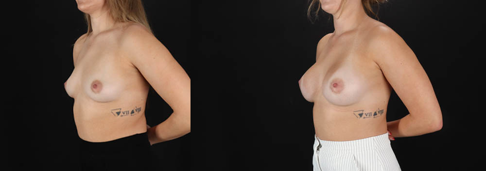 Breast Augmentation case #261355