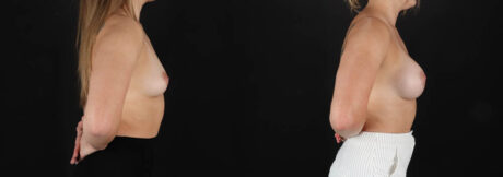 Breast Augmentation case #261355