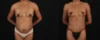 Mommy Makeover case #261377 slider thumbnail