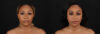 Submental Liposuction case #261395 slider thumbnail