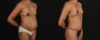 Mommy Makeover case #261377 slider thumbnail