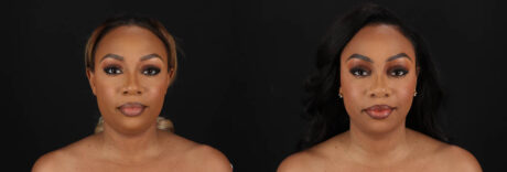 Submental Liposuction case #261395