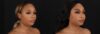 Submental Liposuction case #261395 slider thumbnail