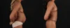 Mommy Makeover case #261377 slider thumbnail