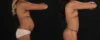 Mommy Makeover case #261377 slider thumbnail
