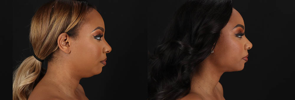 Submental Liposuction case #261395