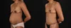 Mommy Makeover case #261377 slider thumbnail