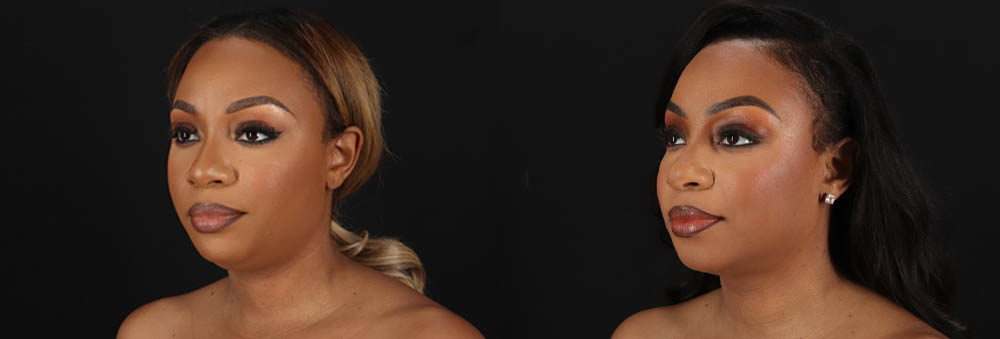 Submental Liposuction case #261395