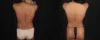 Mommy Makeover case #261377 slider thumbnail