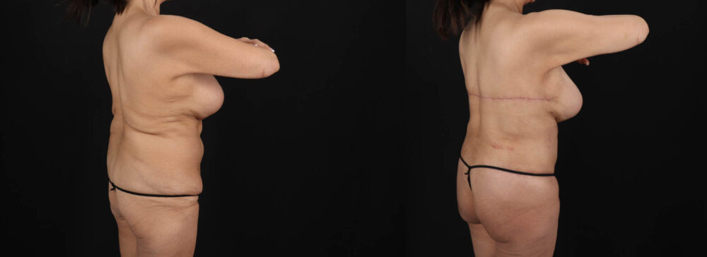 Post Bariatric Surgery (Massive Weight Loss) case #261401